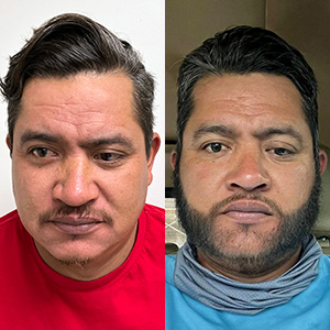 Juan Carlos Trasplante de barba antes y después
