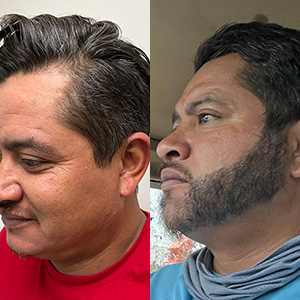Juan Carlos Trasplante de barba antes y después