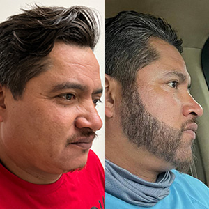 Juan Carlos Trasplante de barba antes y después