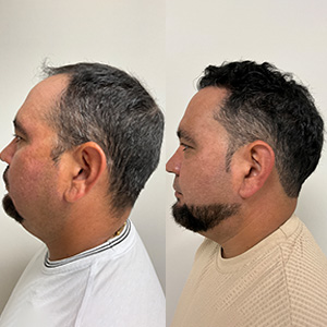 Luis Sanchez Transformación del Cabello Antes y Después