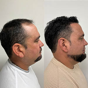 Luis Sanchez Transformación del Cabello Antes y Después