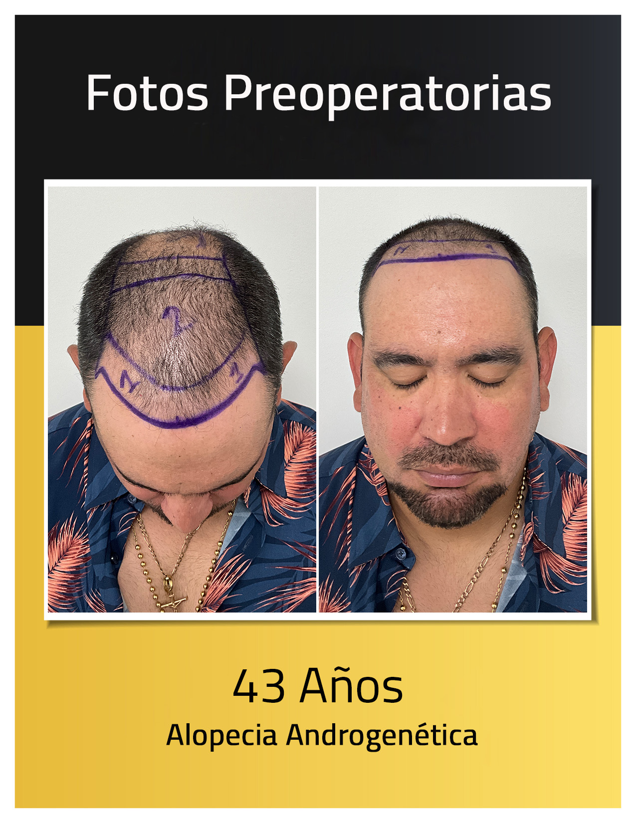 Fotos preoperatorias del trasplante capilar de Luis Sánchez