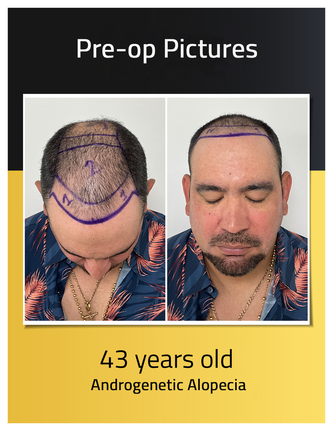 Pre-operative photos of Luis Sanchez's hair transplant