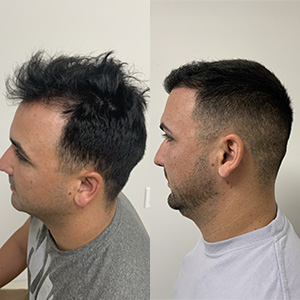Resultado del trasplante de cabello de Miguel lado izquierdo