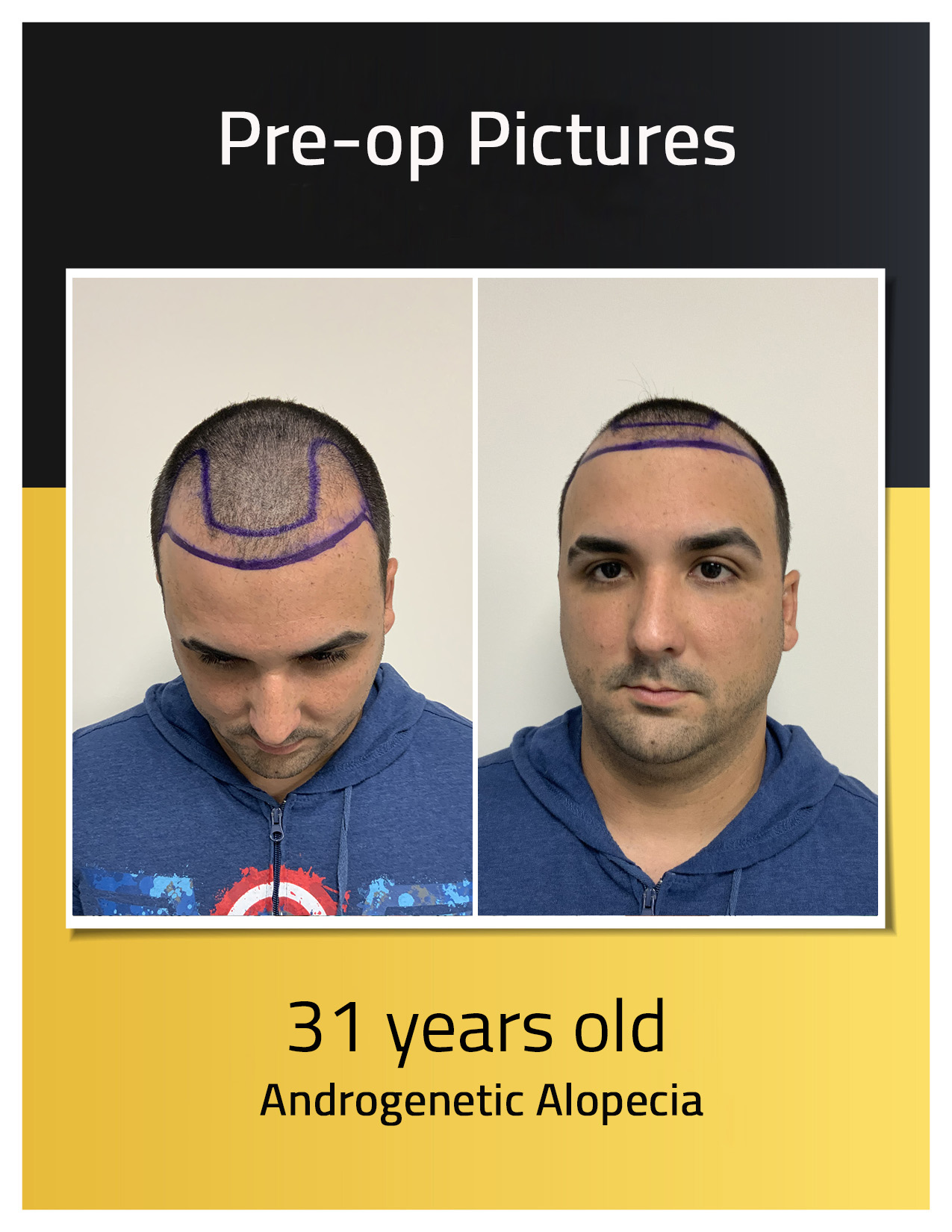 Miguel transplant Pre-op photos