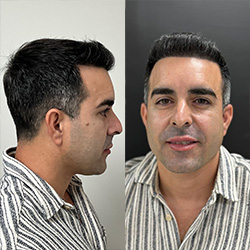 Fotos después del trasplante de cabello de ángel