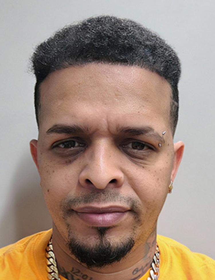 Paciente afro-americano foto de transplante capilar depois