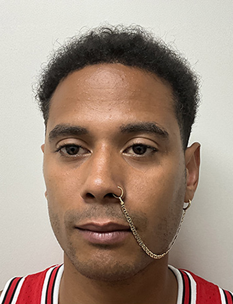 Imagem de cabelo depois do transplante capilar