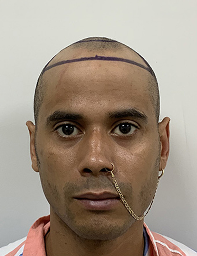 Imagem de cabelo antes do transplante capilar
