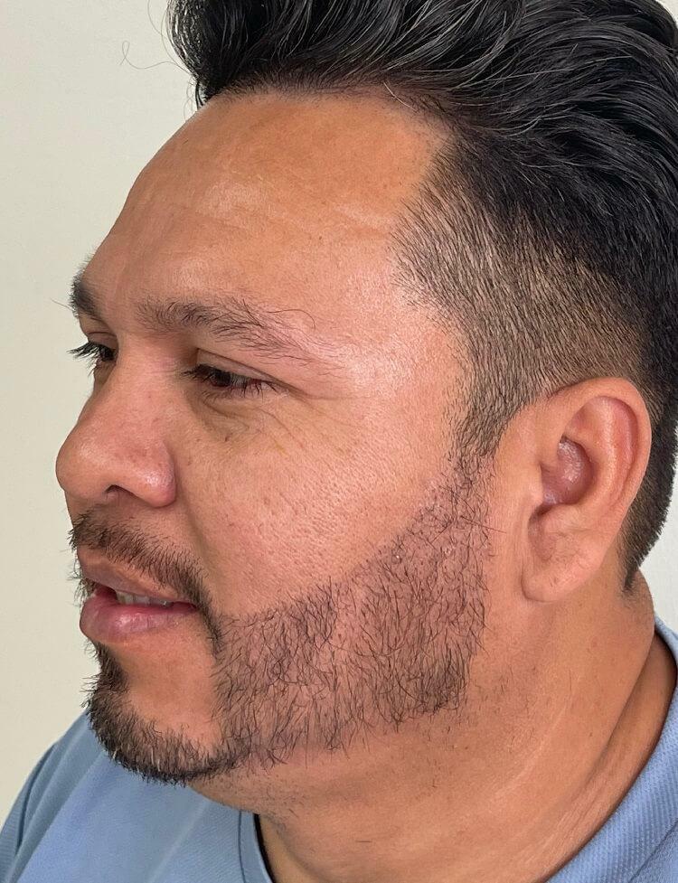 Restauracion del vello facial antes y despues