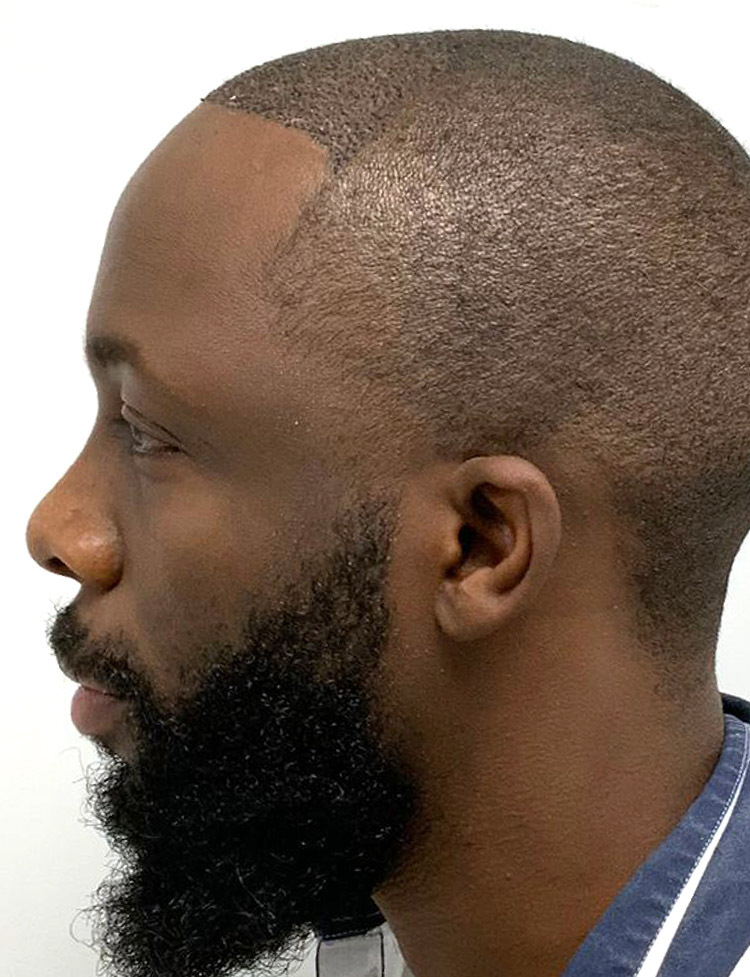 paciente afroamericano photo de trasplante de cabello despues