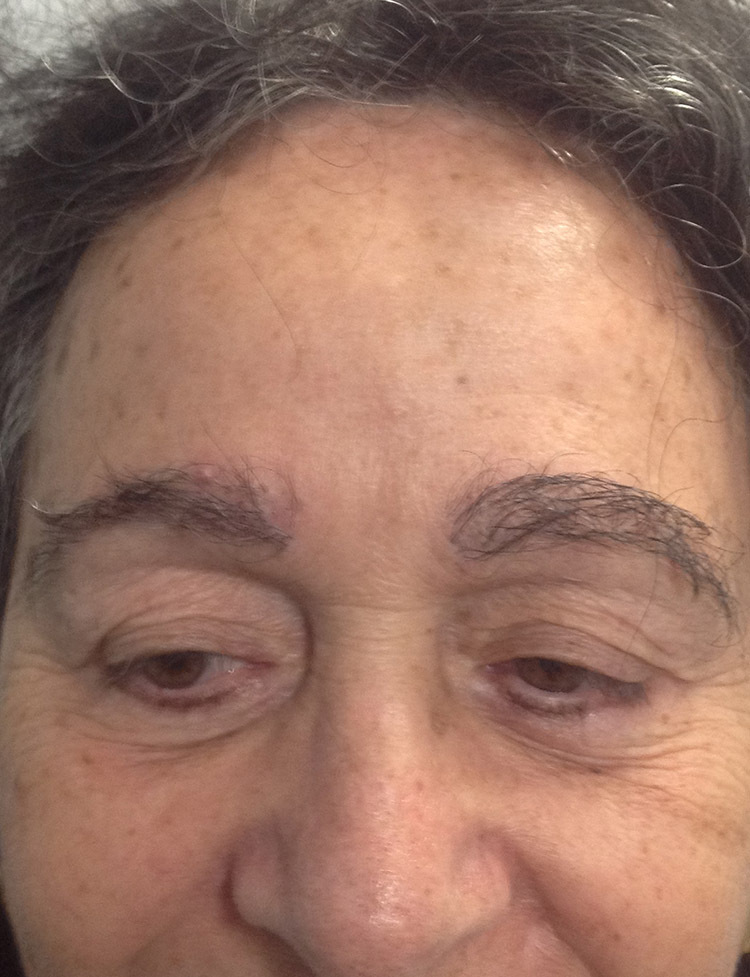 trasplante de cejas en Miami antes y despues