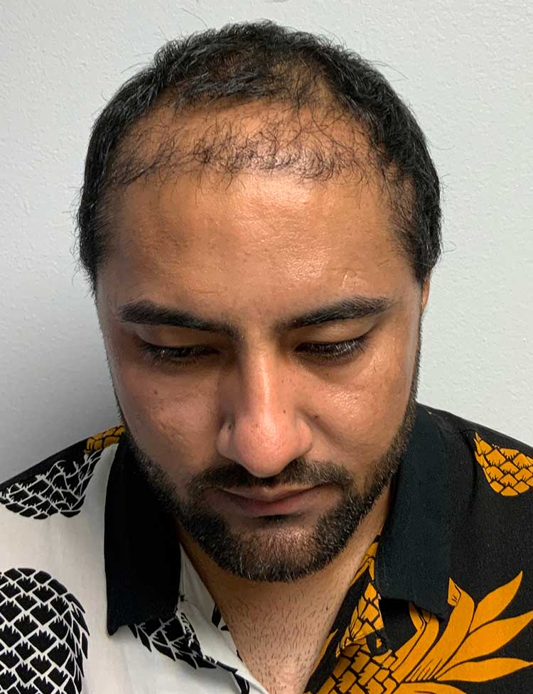 automated fue hair restoration before