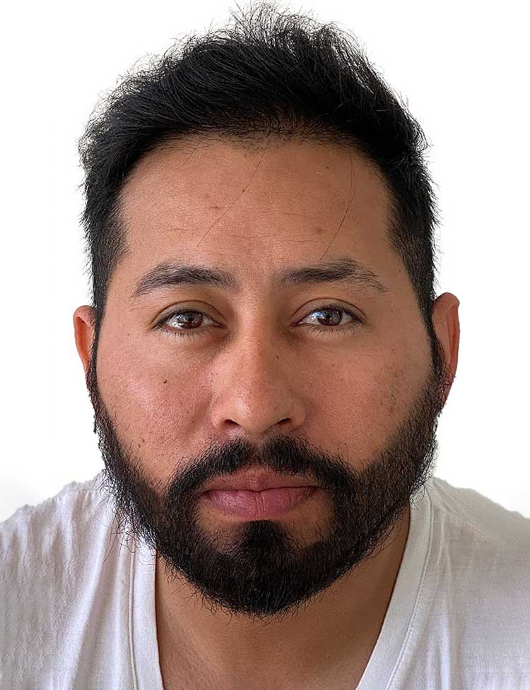 Trasplante de barba en Miami despues