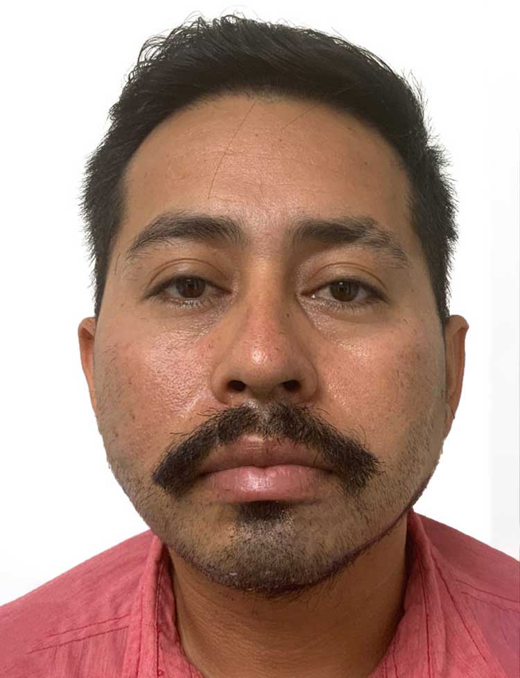 Trasplante de barba en Miami antes