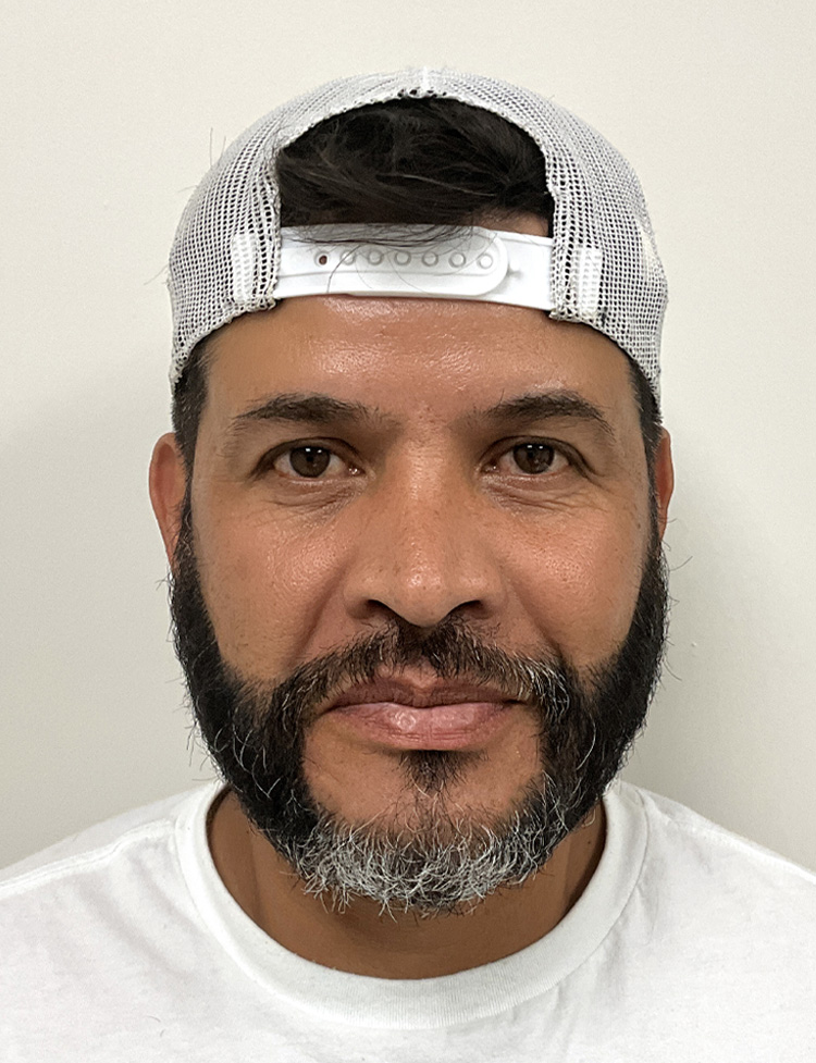 Transplante de barba em Miami depois