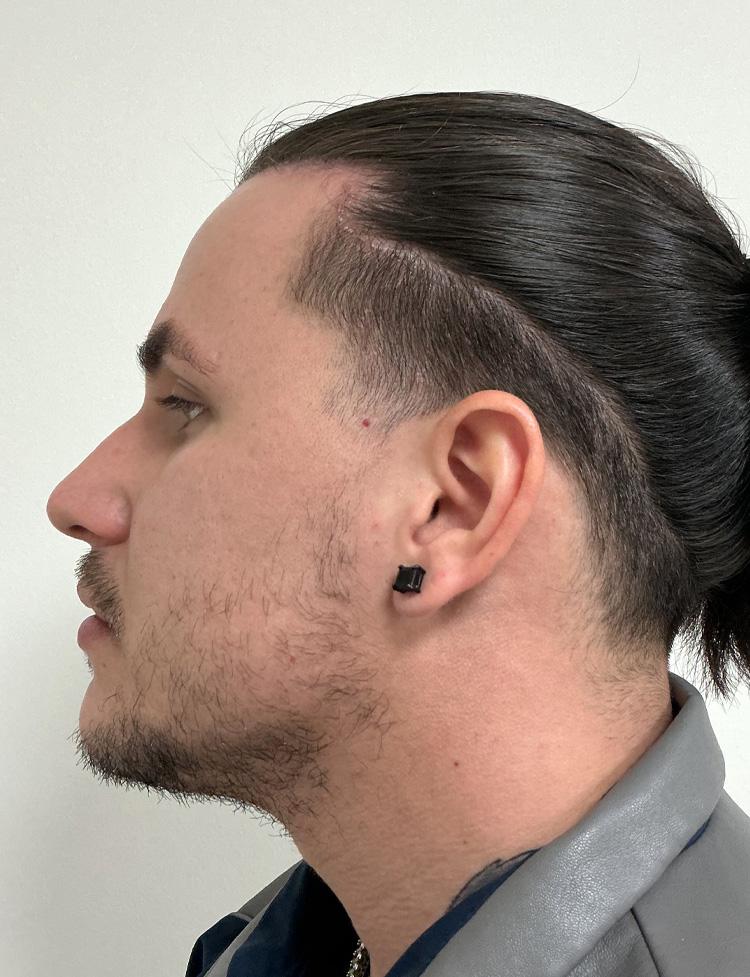 Restauração de pelo facial antes