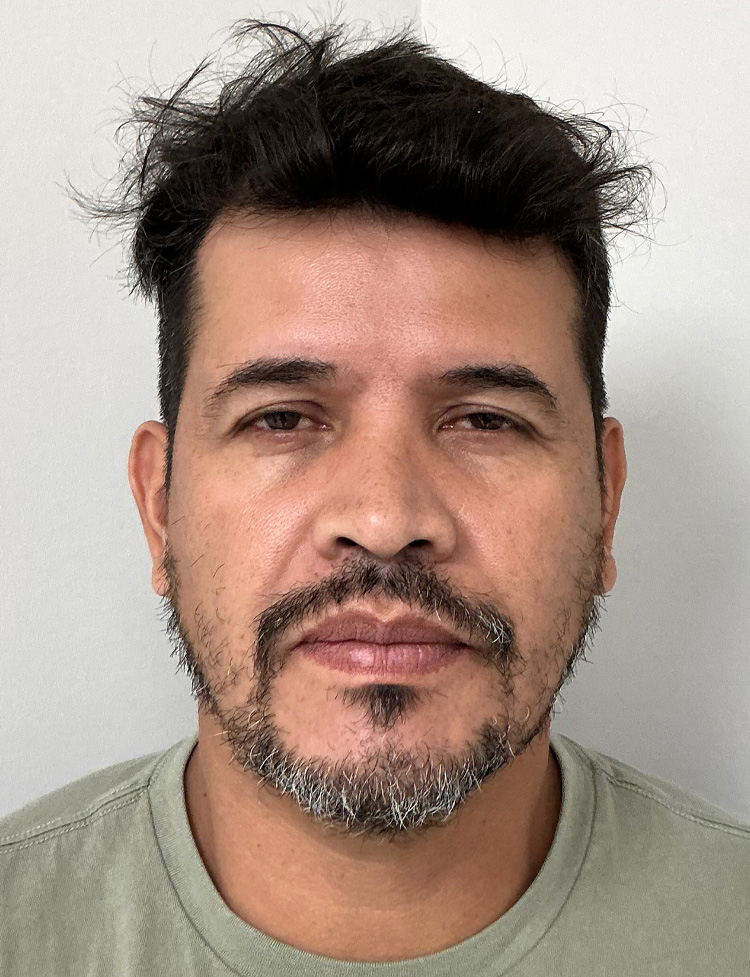 Transplante de barba em Miami antes