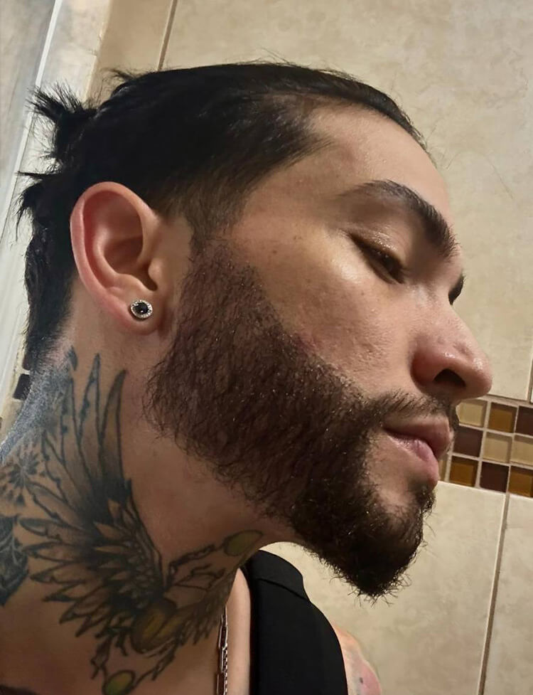 beard transplant before and after