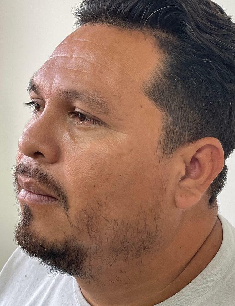 Restauracion del vello facial antes y despues