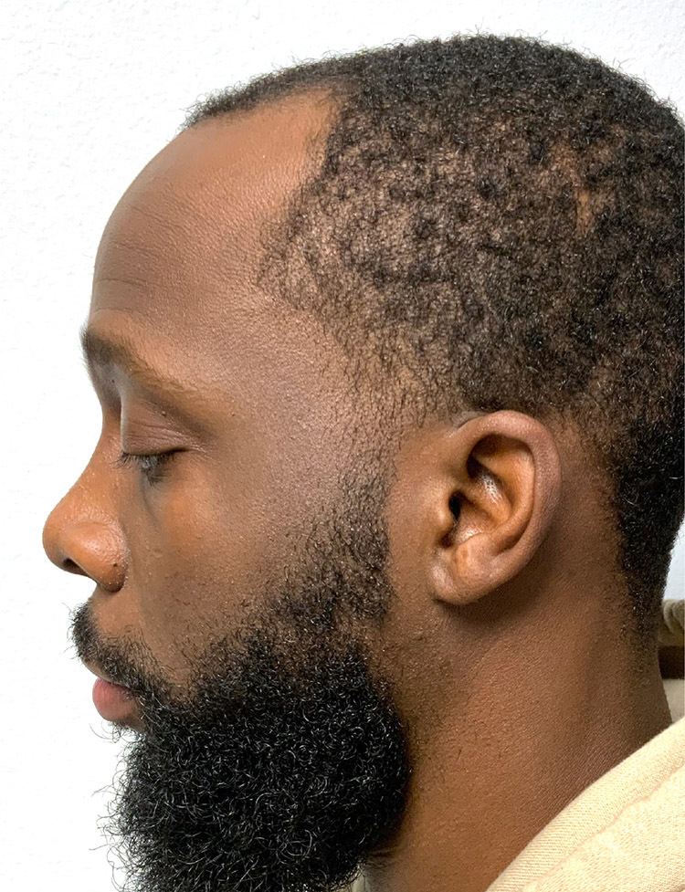 paciente afroamericano photo de trasplante de cabello antes