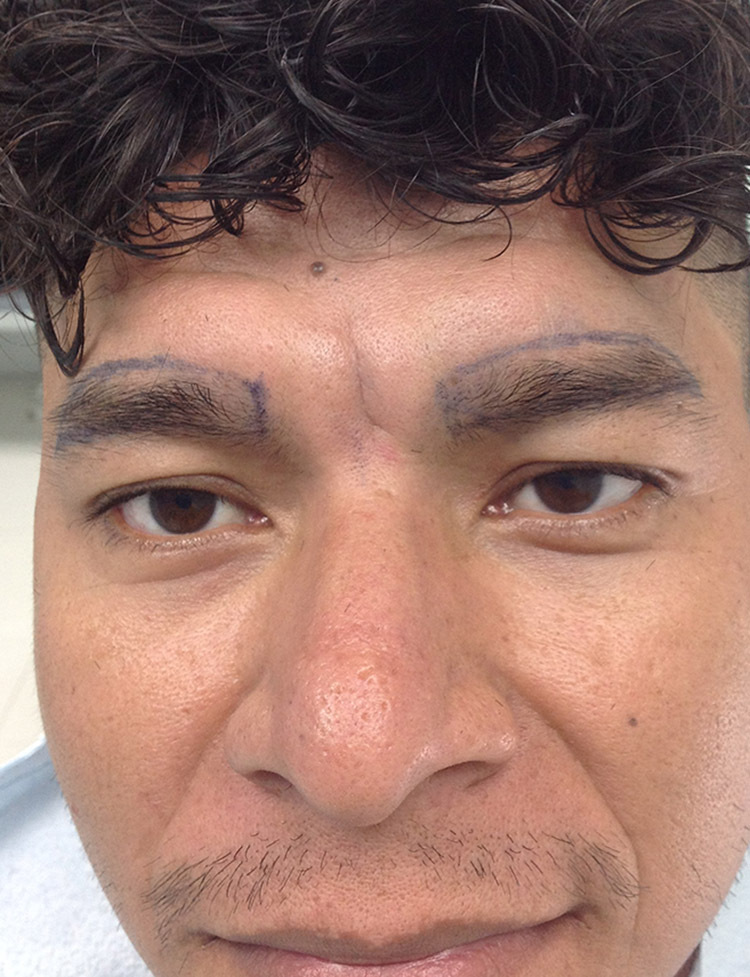 trasplante de cejas antes y despues