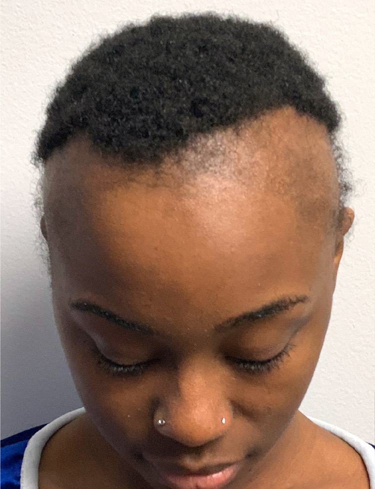 Ethnic female hair transplant before