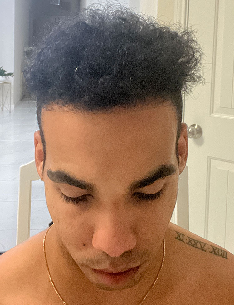 imagen de Cabello despues del trasplante capilar