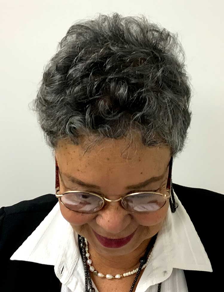 female hair transplant after