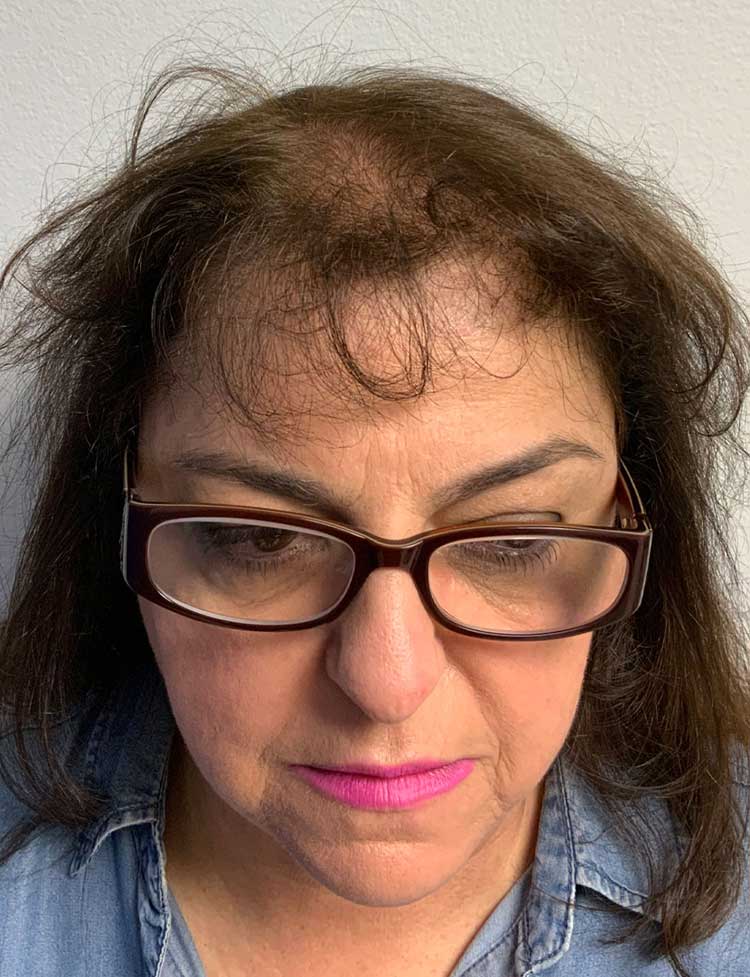 NeoGraft hair transplant female patient before