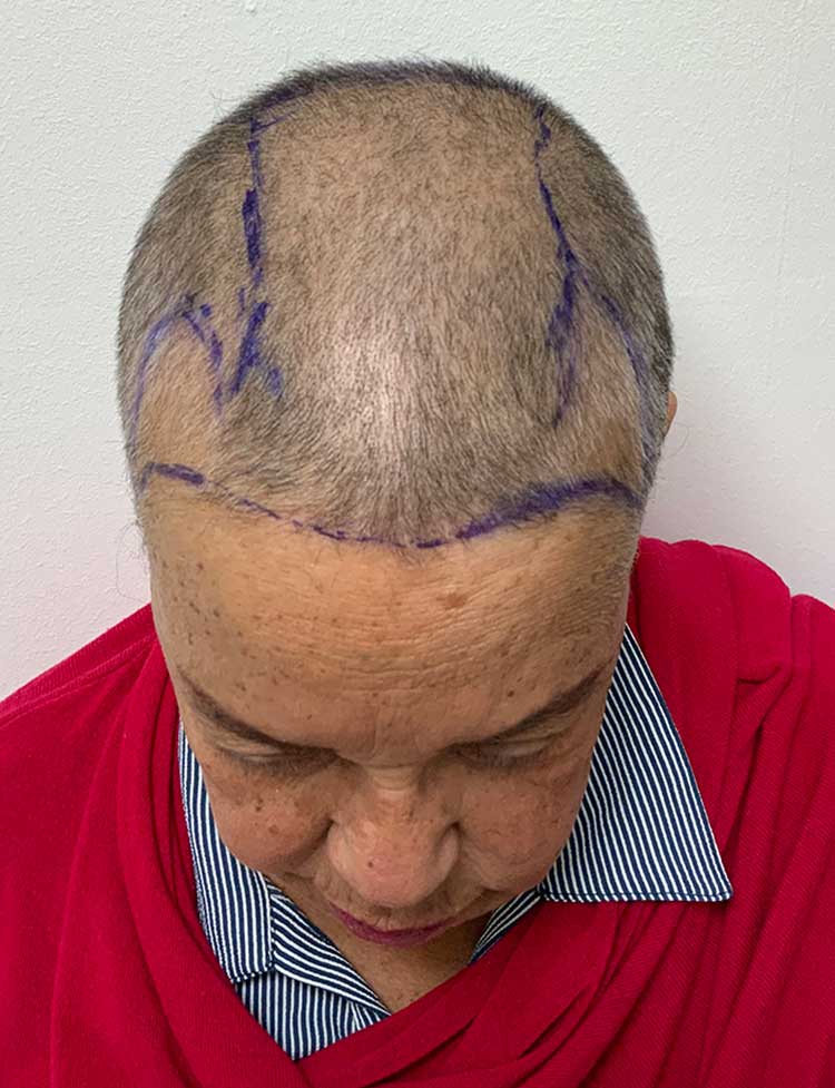 female hair transplant before