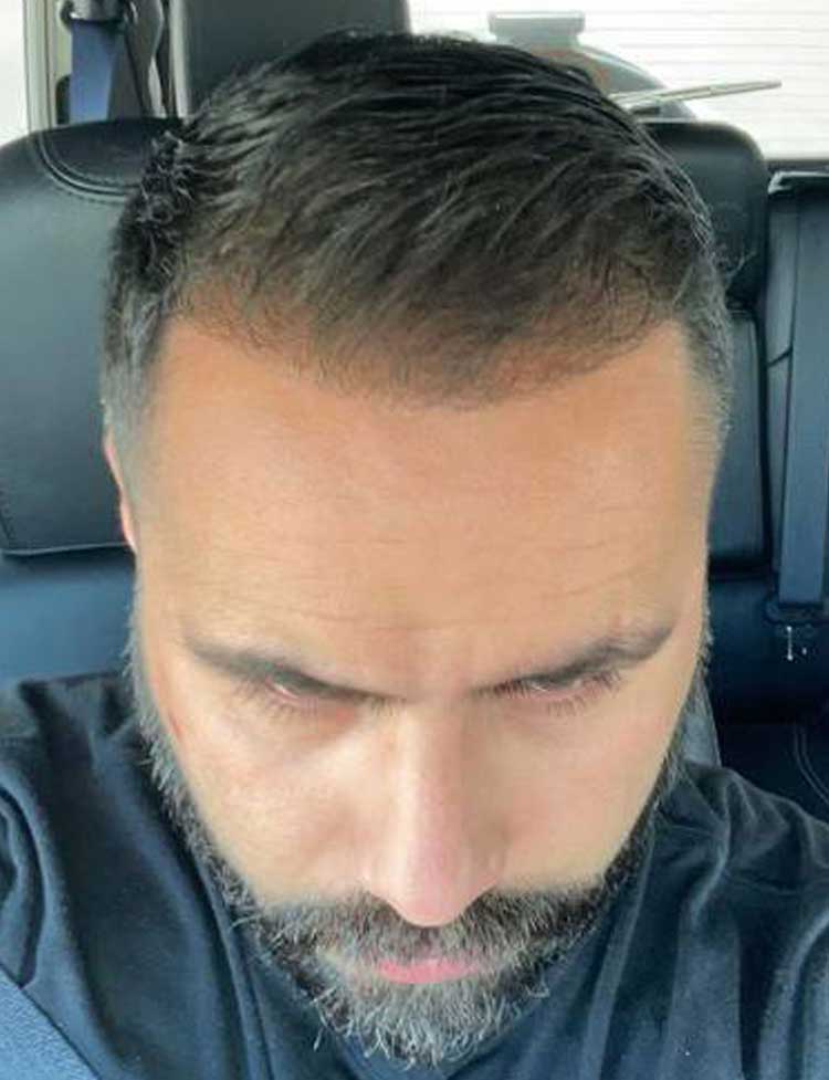 hair transplant frontal line 34y patient after