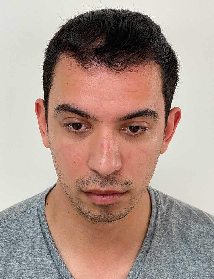 NeoGraft hair transplant Miami after