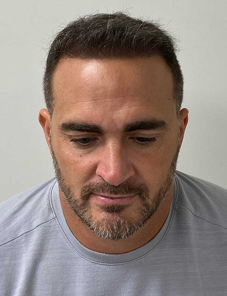 FUE trasplante de cabello después