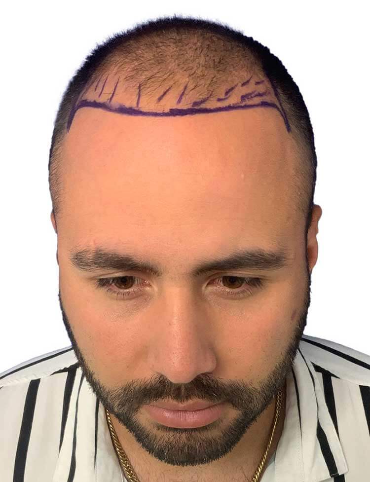 hair transplant frontal line 34y patient before 