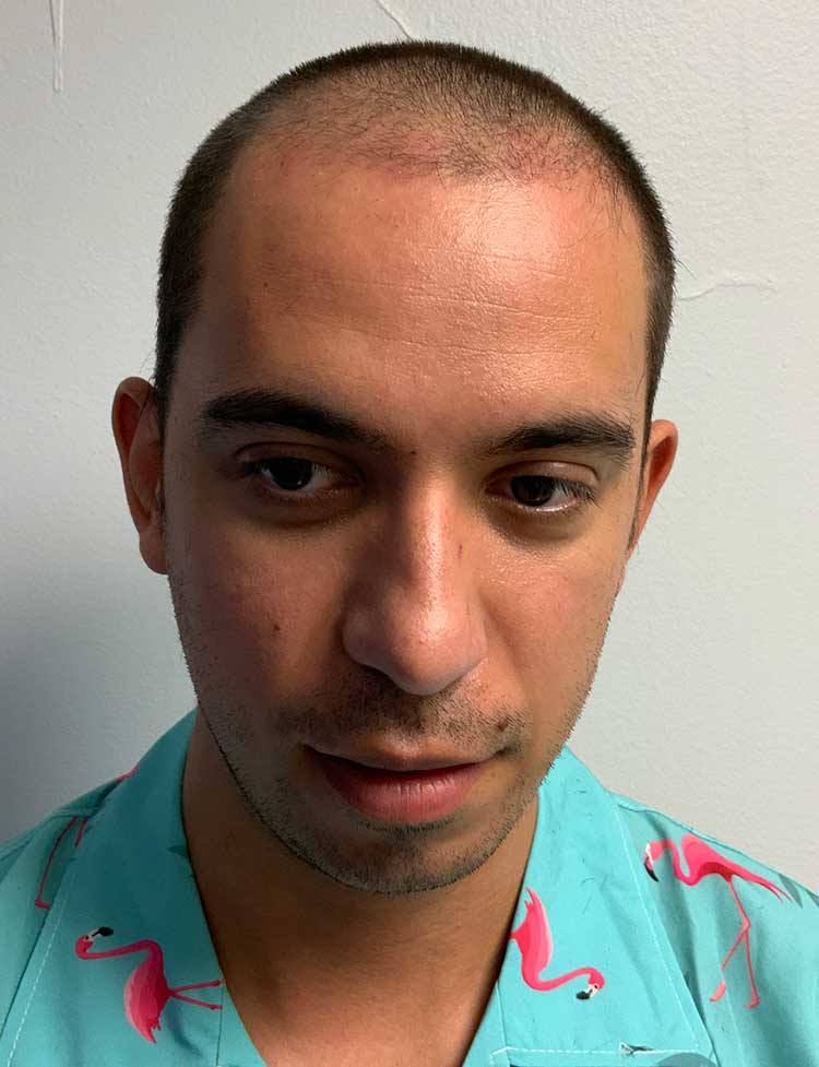 NeoGraft hair transplant Miami before