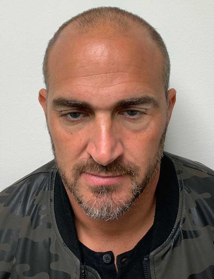 FUE trasplante de cabello antes