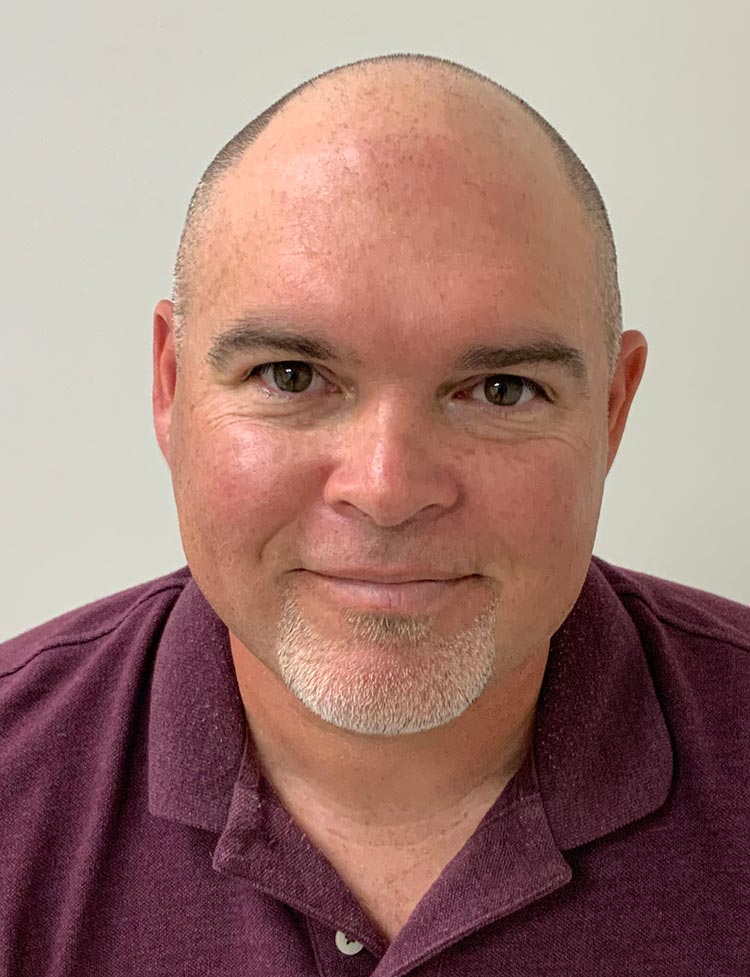 Foto antes de la restauración capilar con técnica FUE de zafiro