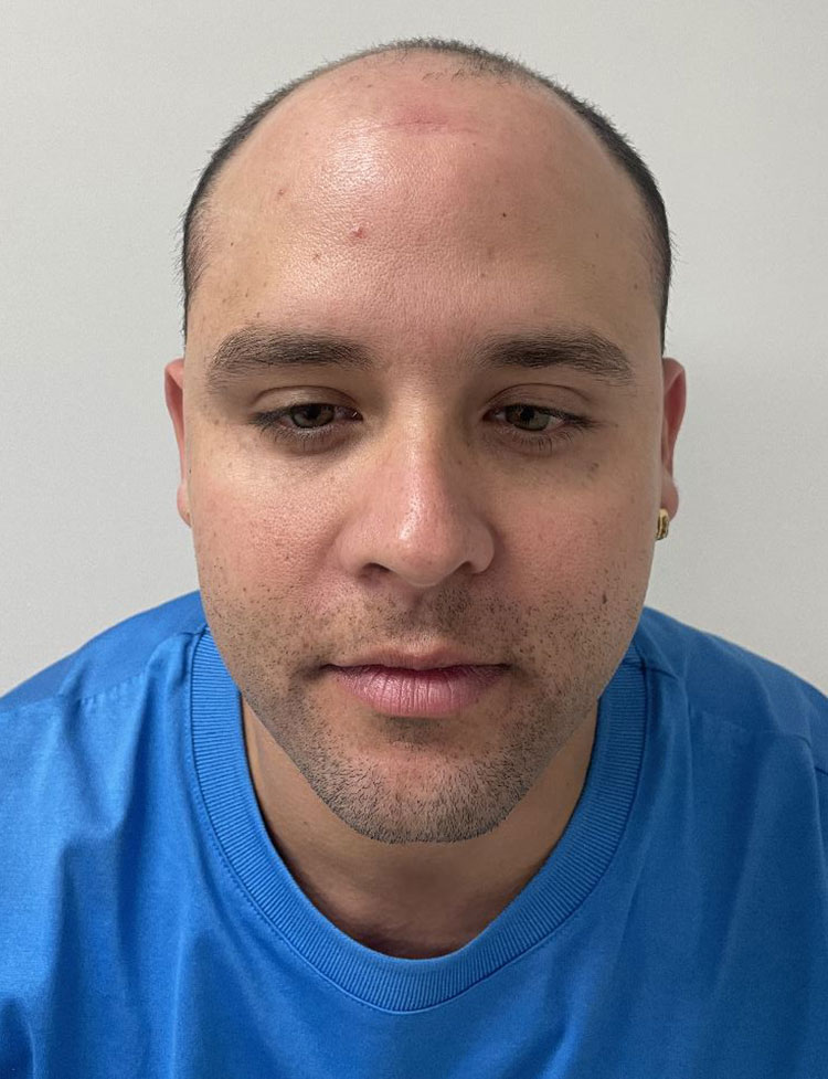 Trasplane DHI foro de antes