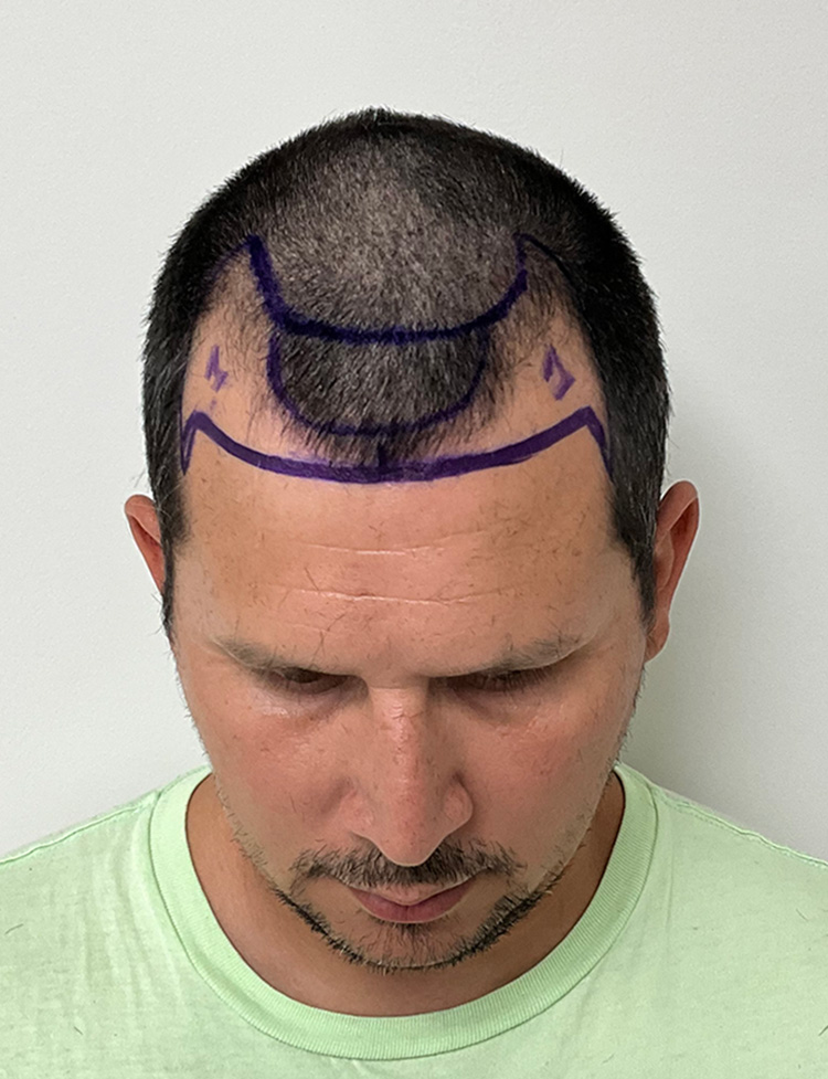 hair restoration before and after