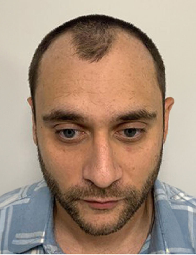 Restauración del cabello paciente real antes