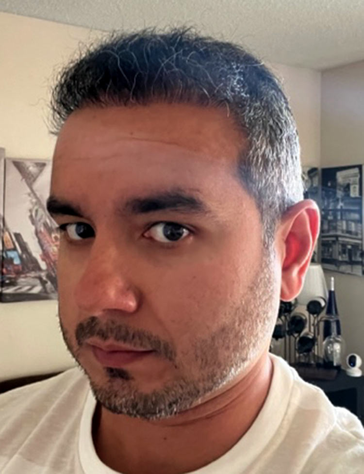 robotic hair transplant miami after photo