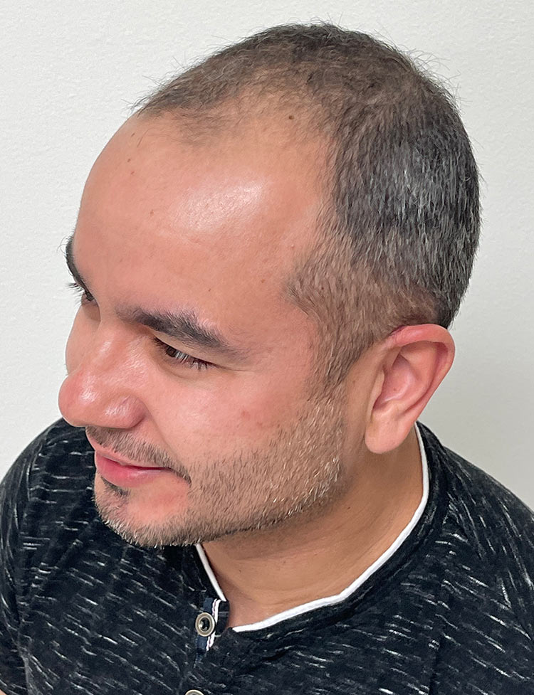 robotic hair transplant miami before photo