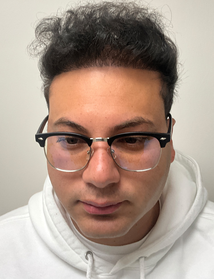 hair transplant Miami after