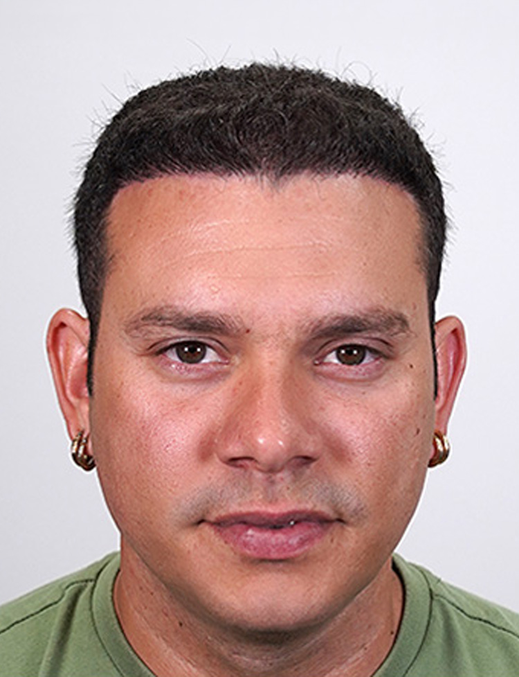 Foto do depois de transplante capilar paciente com 2.500 folículos