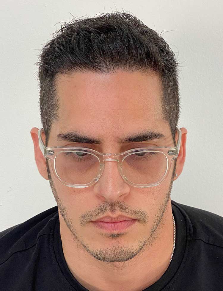 hair transplant after