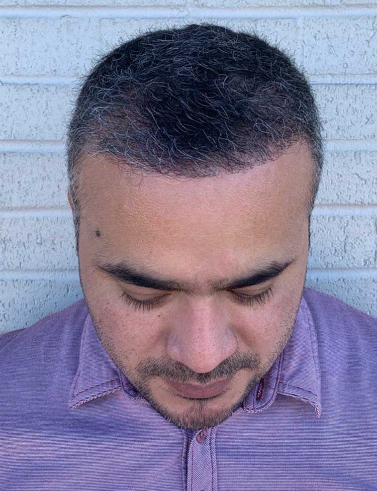 hairline restoration 2000 grafts after