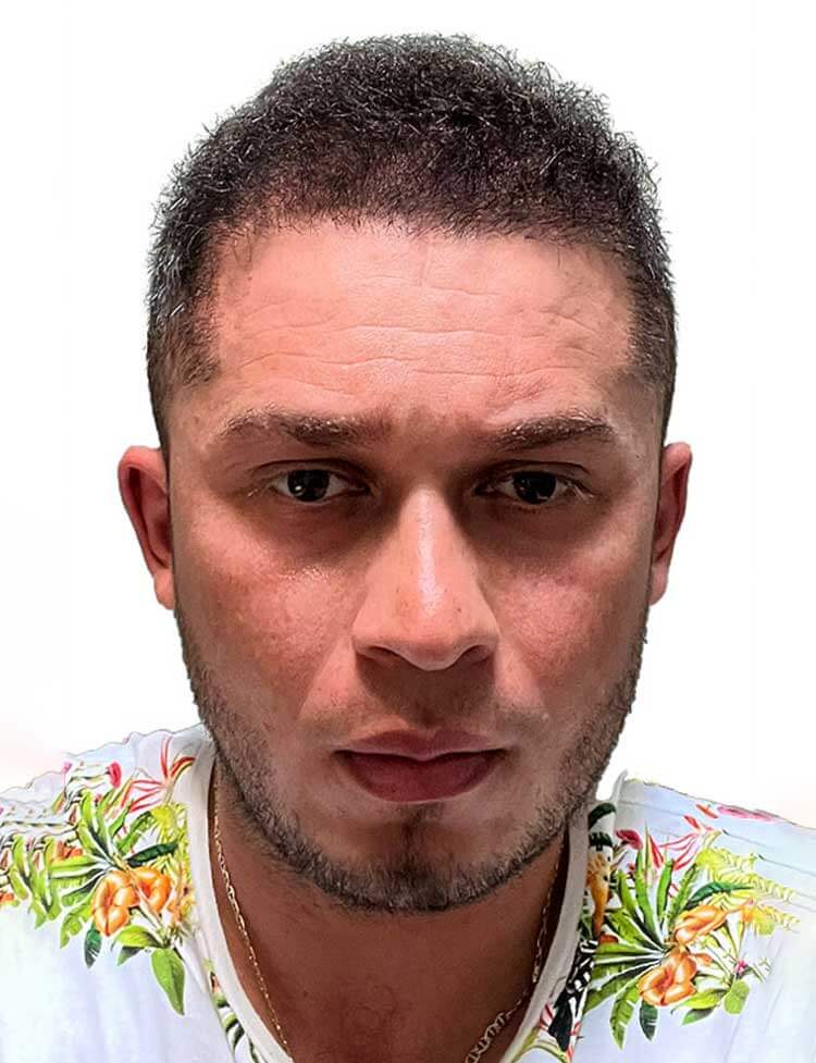 Trasplante de pelo Étnico en Miami despues