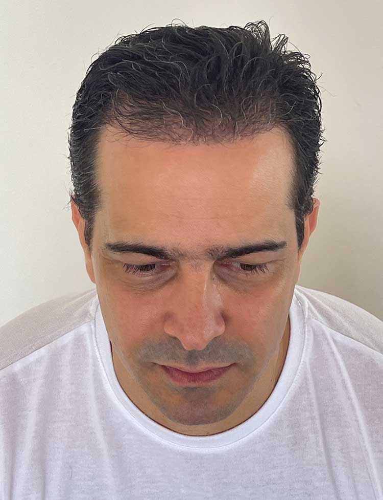 hairline restoration after photo