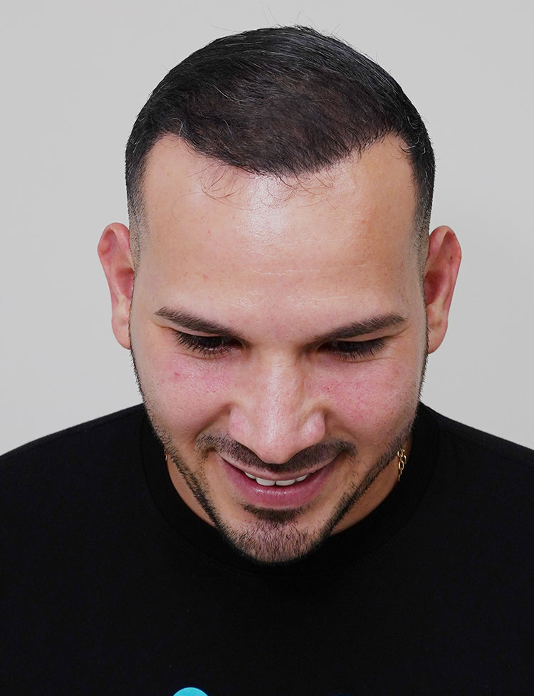 Despues de la Restauracion de la linea frontal con DHI 3000 foliculos